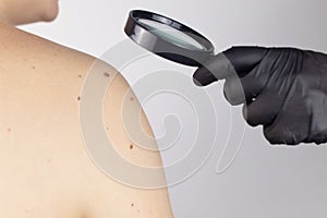 A man at a dermatologist appointment shows his birthmarks, moles and nevi. The doctor examines the patient with a dermatoscope.