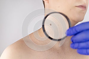 A man at a dermatologist appointment shows his birthmarks, moles and nevi. The doctor examines the patient with a dermatoscope.