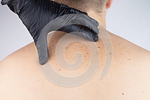 A man at a dermatologist appointment shows his birthmarks, moles and nevi. The doctor examines the patient with a dermatoscope. photo