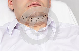 A man with a double chin in the office of a plastic surgeon. Marking with a black dash-dot line marker for double chin
