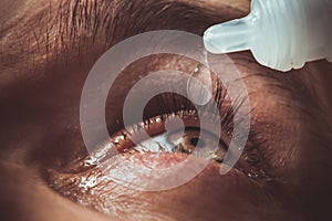 A man drips open human eye with bright red arteries drops to improve vision close up. irritation and redness of the eyeball.