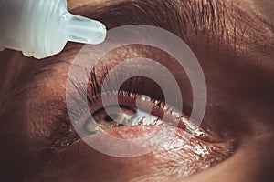 A man drips open human eye with bright red arteries drops to improve vision close up. irritation and redness of the eyeball.