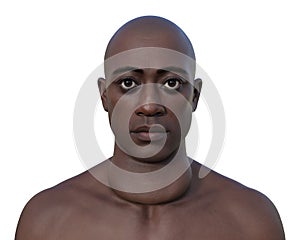 A man with enlarged thyroid gland, 3D illustration