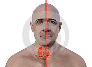 A man with enlarged thyroid gland, 3D illustration