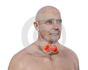 A man with enlarged thyroid gland, 3D illustration