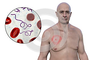 A man with erythema migrans, a characteristic rash of Lyme disease caused by Borrelia burgdorferi, 3D illustration