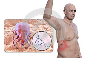 A man with erythema migrans, a characteristic rash of Lyme disease caused by Borrelia burgdorferi, 3D illustration