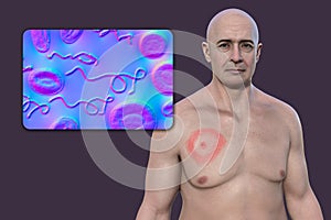 A man with erythema migrans, a characteristic rash of Lyme disease caused by Borrelia burgdorferi, 3D illustration