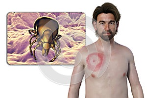 A man with erythema migrans, a characteristic rash of Lyme disease caused by Borrelia burgdorferi, 3D illustration