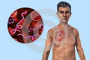 A man with erythema migrans, a characteristic rash of Lyme disease caused by Borrelia burgdorferi, 3D illustration