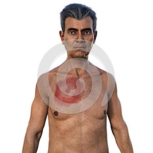 A man with erythema migrans, a characteristic rash of Lyme disease caused by Borrelia burgdorferi, 3D illustration