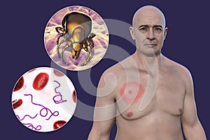 A man with erythema migrans, a characteristic rash of Lyme disease caused by Borrelia burgdorferi, 3D illustration photo