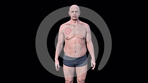 A man with erythema migrans in Lyme disease, 3D animation