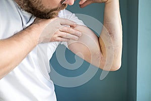 Man examines a large bruise on his arm caused by an injury. Close-up.