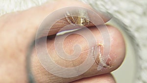 A man examines with a magnifying glass a toenail affected by a fungus.