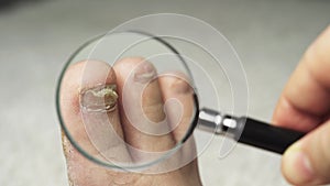 A man examines with a magnifying glass a toenail affected by a fungus.