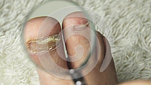 A man examines with a magnifying glass a toenail affected by a fungus.