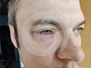 Man eye with barley, stye. Inflammation of eyelid.