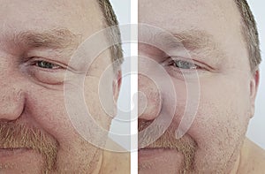 Man eyes bloating bags wrinkles before after health procedures