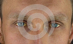 Man eyes obstructive Jaundice yellow discoloration Real people liver dysfunction icteruswith cirrhosis hepatitis symptom