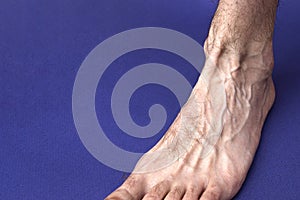 A man foot with a mesh of dilated varicose veins stands on a blue background