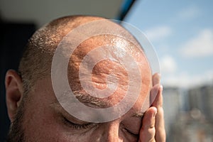 Man forehead sunstroke sweat on face, bald head. Guy suffers from heat high temperature, overheating