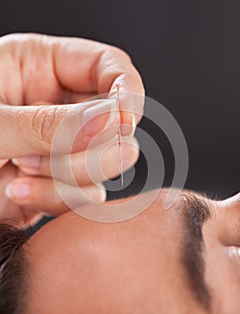Man Getting Acupuncture Treatment