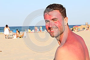 Man getting sunburned at the beach