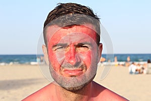 Man getting sunburned at the beach