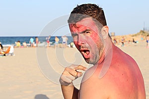 Man getting sunburned at the beach