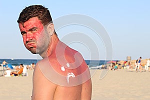 Man getting sunburned at the beach