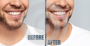 Man before and after gingivoplasty procedure on light background, closeup. Banner design