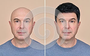 Man with and without hair