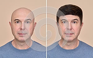 Man with and without hair