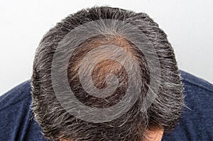 Man with hair loss and grey hair.