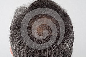 Man with hair loss and grey hair.
