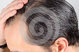 Man hair loss problem