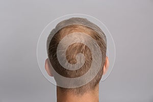 Man with hair loss problem on grey background, back view. Trichology treatment