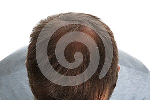 Man with hair loss problem isolated on white, above view