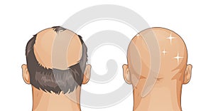 Man with hair loss problem isolated on white background, cartoon style on white