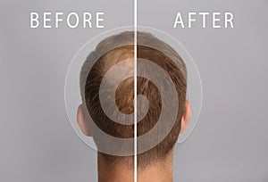 Man with hair loss problem before and after treatment on grey background, collage. Visiting trichologist