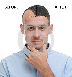 Man before and after hair loss treatment on white background, collage