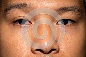 A man has red eyes caused by conjunctivitis or eye inflection disease