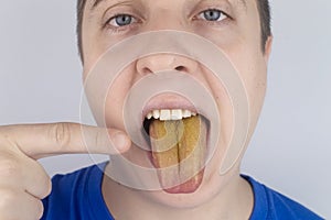 The man has a yellow tongue. Painful yellow coating on the mucous membrane of the tongue. Diseases of the gastrointestinal tract,
