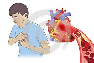 Man have chest pain from blood cell can`t flow into heart by fatty.