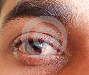 A man have pterygium is in the eye. photo