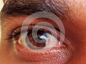 A man have pterygium is in the eye. photo