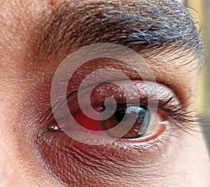 A man have pterygium is in the eye. photo