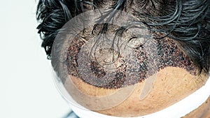 Man head with hair transplant surgery with receding hair line, FUE, Follicular unit extraction, Types of hair transplant