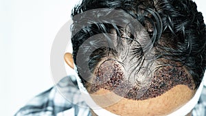 Man head with hair transplant surgery with receding hair line, FUE, Follicular unit extraction, Types of hair transplant